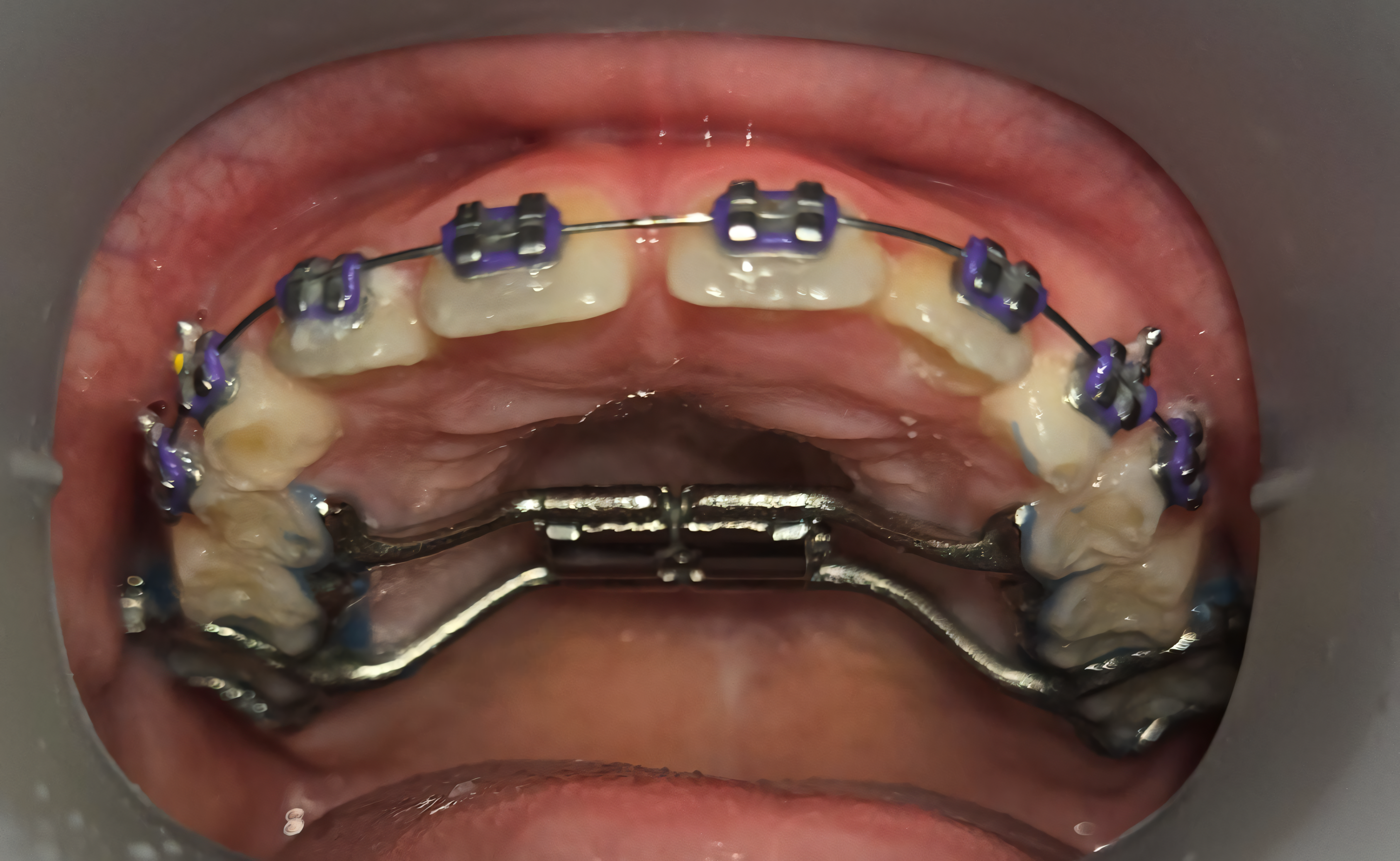 Phase 1 orthodontic treatment for children in Buffalo Grove, IL